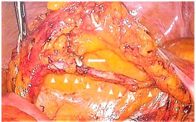 Clinical impact of inferior mesenteric vein preservation during left hemicolectomy with low ligation of the inferior mesenteric artery for distal transverse and descending colon cancers: A comparative study based on computed tomography